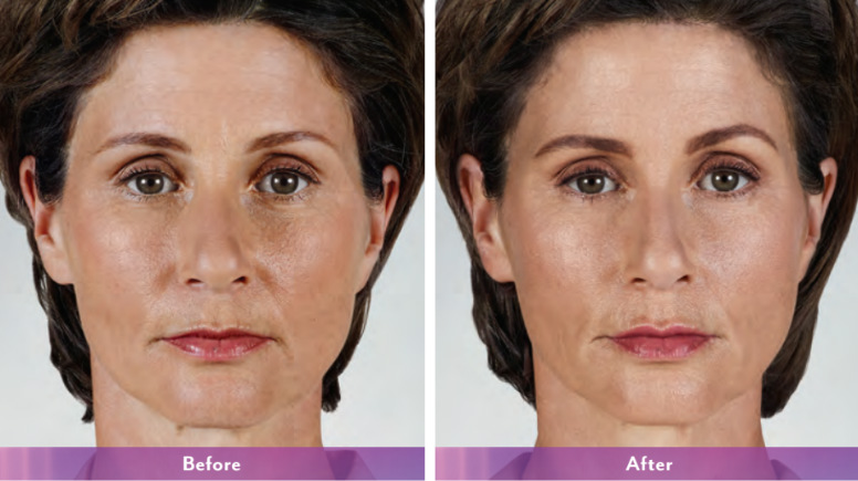 Juvederm before and after photos