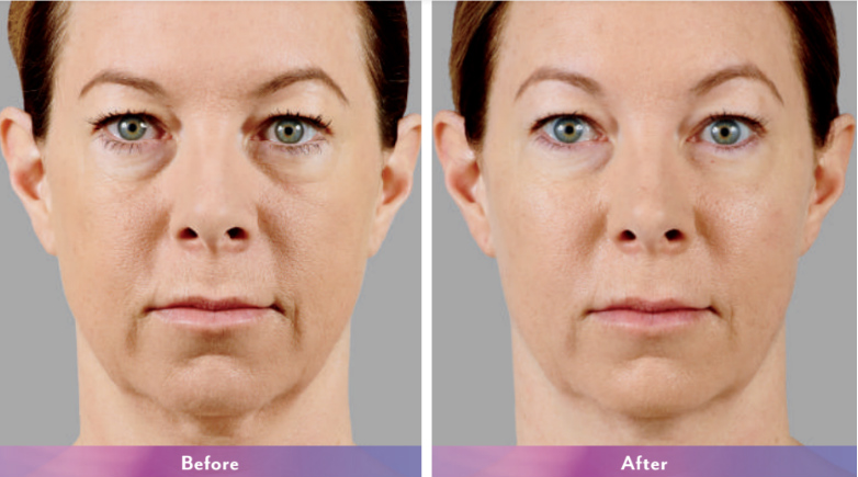 juvederm before and after photos